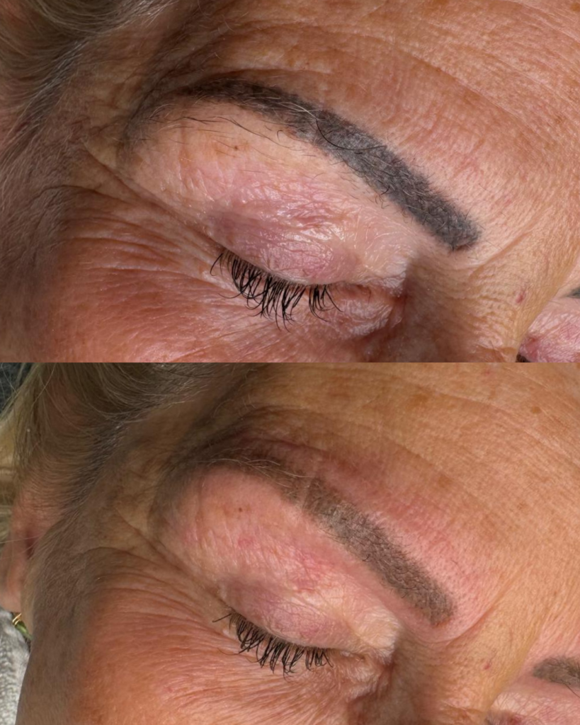 Foola Beauty laser before - after wenkbrauw